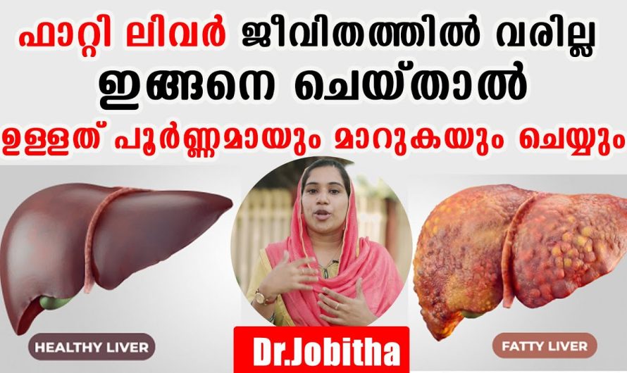 ഫാറ്റി ലിവർ ജീവിതത്തിൽ നിന്നും അകറ്റണോ? ഉള്ളത് പൂർണ്ണമായി മാറുകയും ചെയ്യും! ജീവന്റെ വിലയുള്ള ഇൻഫർമേഷൻ ശ്രദ്ധിക്കുക!