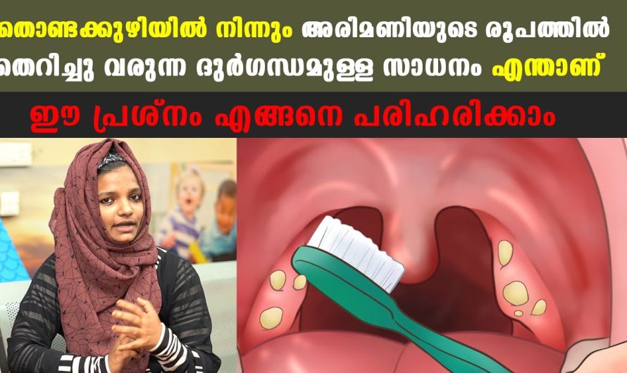 തൊണ്ടയിൽ ഉണ്ടാകുന്ന ഈ പ്രശ്നം എങ്ങനെ പരിഹരിക്കാം!