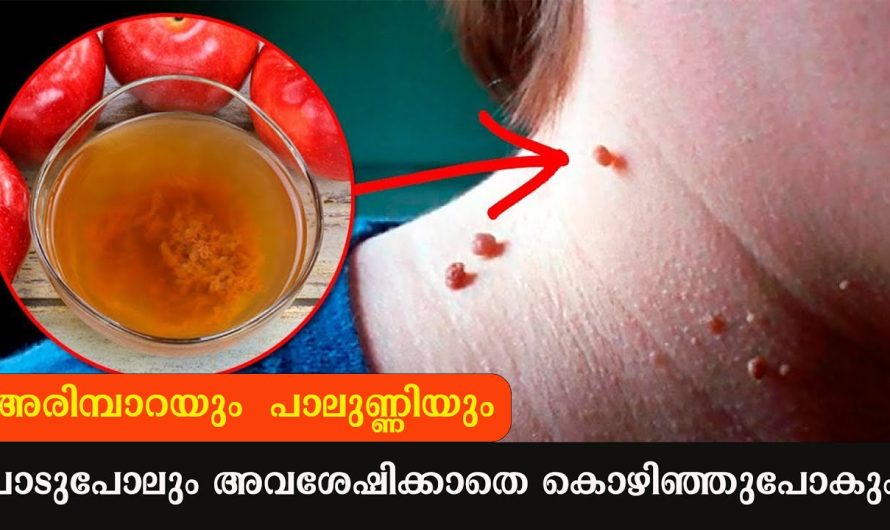 അരിമ്പാറയും പാലുണ്ണിയും കൊഴിഞ്ഞുപോകും ഇങ്ങനെ ചെയ്താൽ