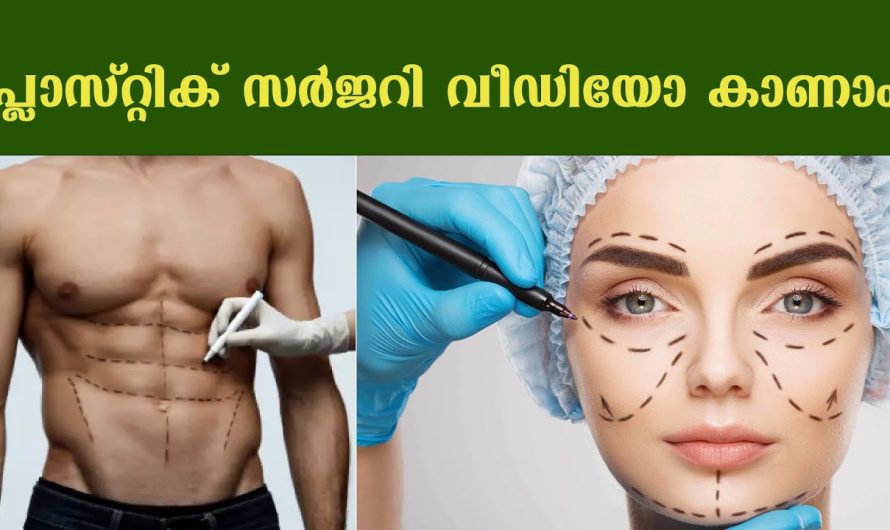 പ്ലാസ്റ്റിക് സർജറി ചെയ്യുന്നത് കണ്ടിട്ടുണ്ടോ???