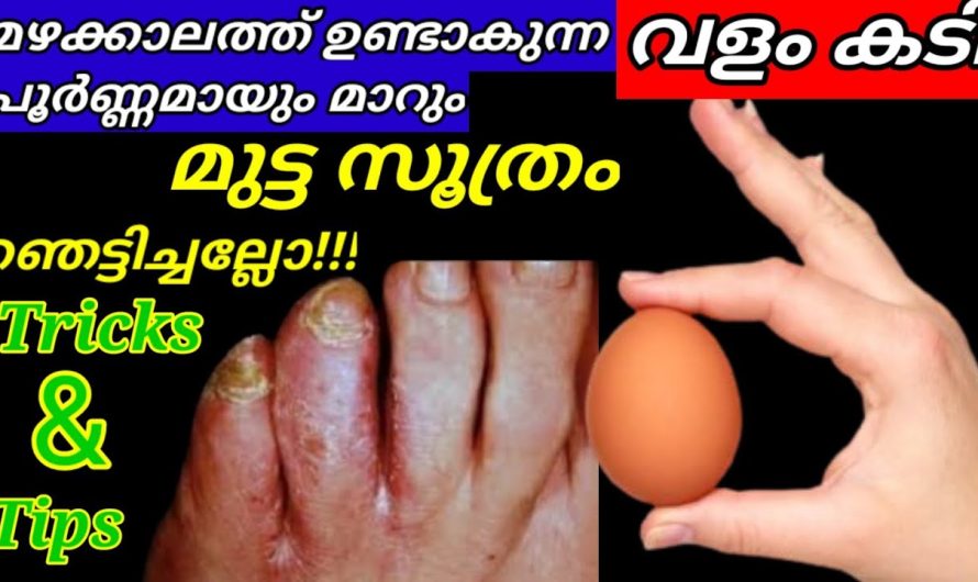 കാലിൽ വളം കടി ഉണ്ടോ? പരിഹാരം ഇതാ