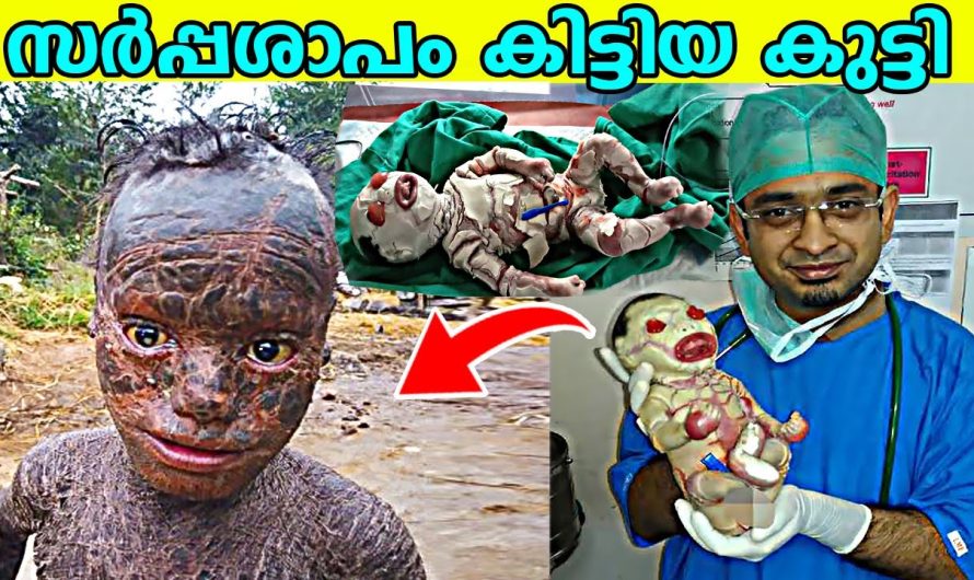 ഡോക്ടർമാർ പോലും ഞെട്ടി അപൂർവ രോഗം ബാധിച്ച കെവിൻ