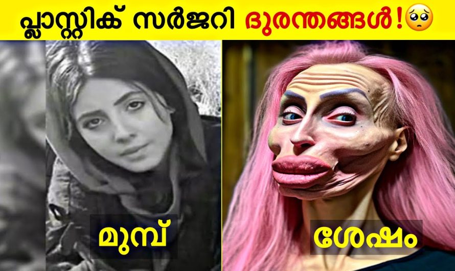 പ്ലാസ്റ്റിക് സർജറി ചെയ്ത് പണി പാളി🥲