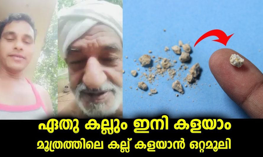 മൂത്രത്തിൽ കല്ല് ഉള്ളവർക്ക് ഒരൊറ്റമൂലി പ്രയോഗം…ഏതു കല്ലിനെയും പൊടിച്ചു കളയും
