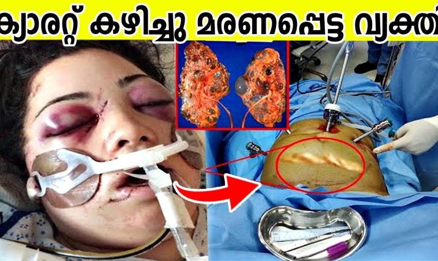 ക്യാരറ്റ് കഴിച്ചു മരണപ്പെട്ട വ്യക്തി | ഇങ്ങനെയും ആളുകൾ മരണപ്പെടുമോ..!