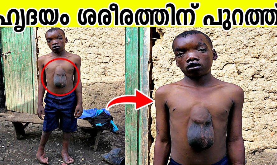 ഹൃദയം ശരീരത്തിന് പുറത്തുള്ള 14 വയസ്സുകാരൻ