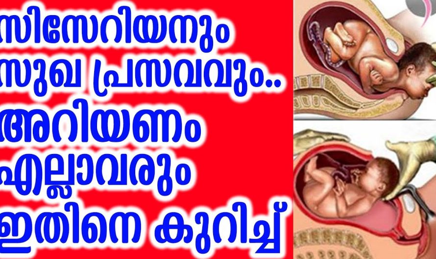 സിസേറിയനും സുഖ പ്രസവവും അറിയണം എല്ലാവരും ഇതിനെ കുറിച്ച്