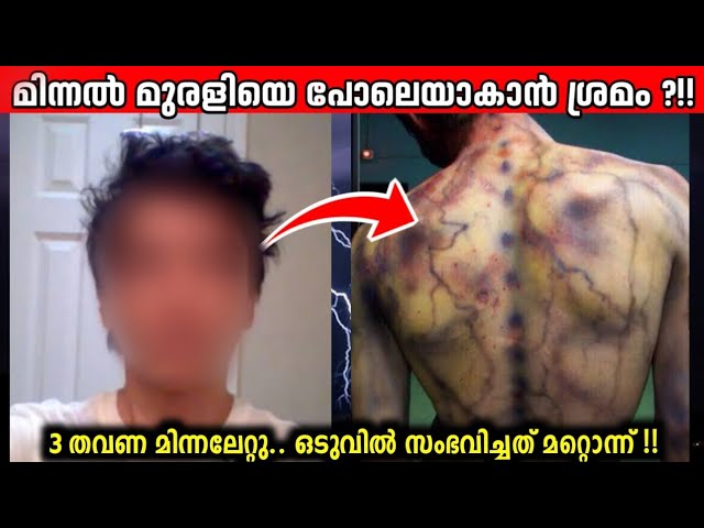 3 തവണ മിന്നലേറ്റു! പിന്നെ നടന്നത് അത്ഭുതം!