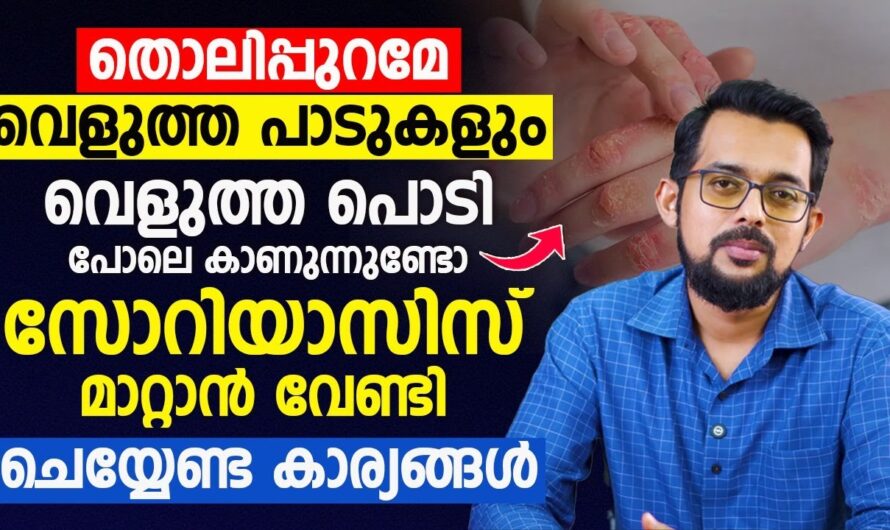 Do you have white powdery patches on your skin? Watch out for these to help treat psoriasis