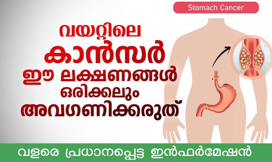Stomach Cancer/Gastric Cancer: Early detection of stomach cancer can help make treatment more effective.