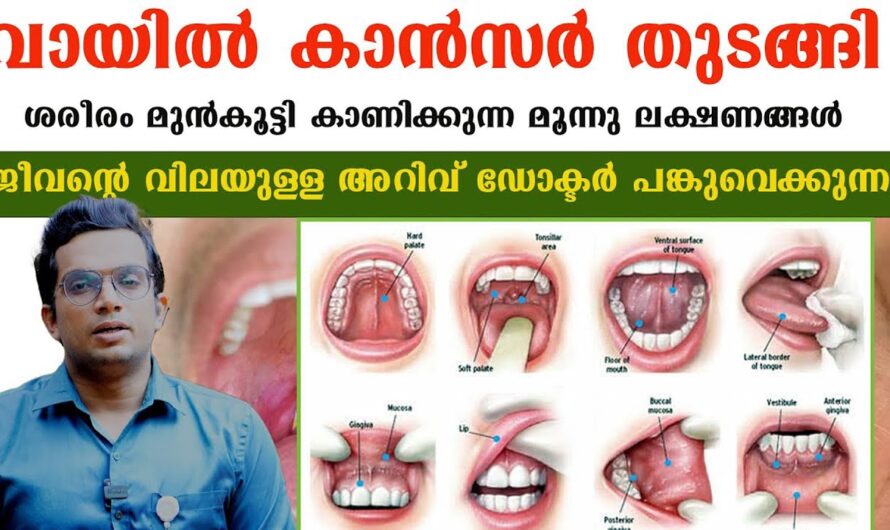 Mouth Cancer: These are the causes! Give up these habits