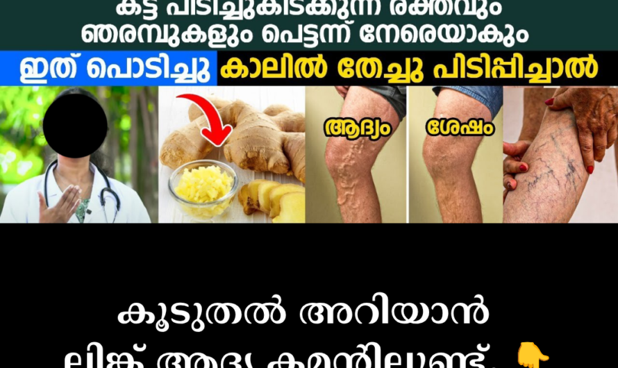 Details about the condition of Varicose Veins are given below: