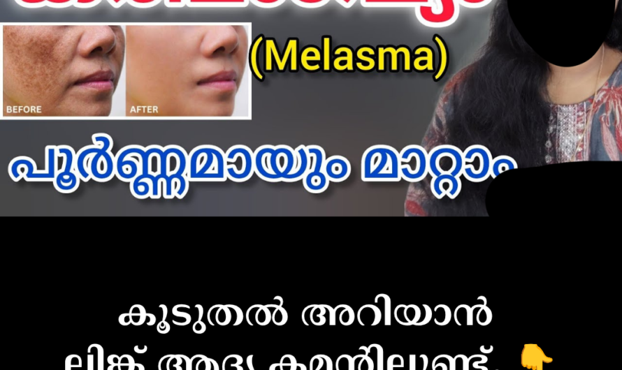 The main causes of melasma on the skin and ways to control them are given below:
